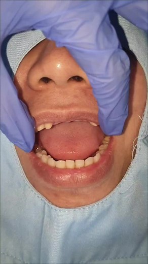 Affordable Crown Teeth Procedure at Bucad Dental Clinic