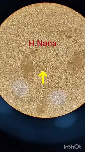 Hymenolepis Nana Parasitic Tapeworm: Microscopic View and Infection Details