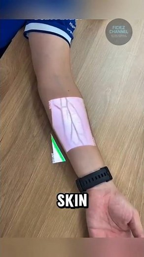 Smart Vein Finder – The Future of Painless Injections #medicaltech #innovation #technology