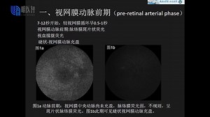 眼科专家周琼教授讲解《FFA及ICGA正常眼底图像》