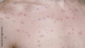 Close-up of chickenpox blisters on human skin. The rash covers the chest and neck areas, indicating a contagious viral infection. This visual represents the discomfort and health challenges of