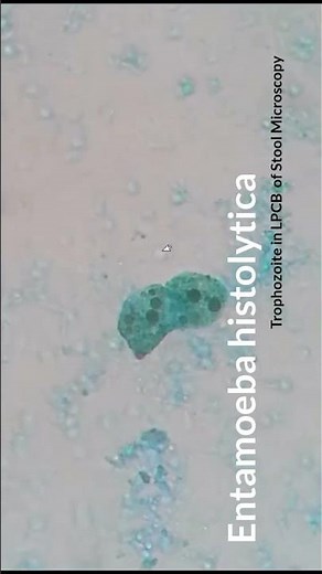 Entamoeba histolytica in Stool Microscopy |Trophozoite |LPCB Stain