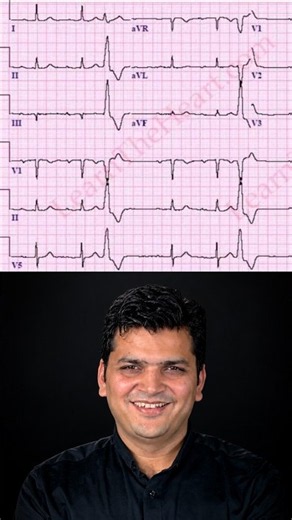 What Does This ECG Pattern Mean?