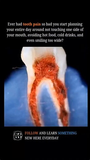 QUANTUMBYTES on Instagram: "The root canal method is a dental procedure used to treat infection or irreversible damage inside a tooth by removing the inflamed or infected pulp tissue from the root canal system, disinfecting the canal, and sealing it to prevent reinfection. The process begins with local anesthesia, followed by creating an access opening in the tooth to reach the pulp chamber; the diseased pulp is then removed using specialized instruments, and the canal is thoroughly cleaned, sha