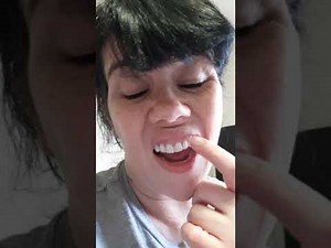 Dentures finally fit