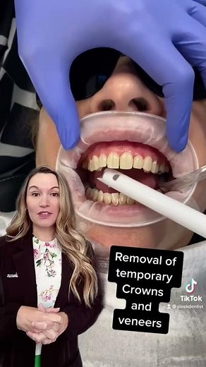 Removal of temporary [provisional] crowns and veneers without pain and no teeth damage.