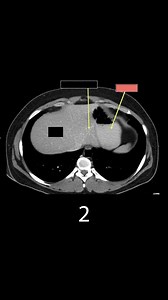 Learn CT Anatomy (part 6) | CTisus: Cutting edge information on body CT (Computed tomography).