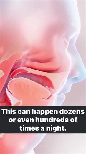 How many times do you stop breathing in your sleep with sleep apnea? 😳 Most people don’t even notice… but it can be serious. Silent, but dangerous for your heart.❤️ #SleepBetter #sleepapnea #sleep #snoring #SleepHealth
