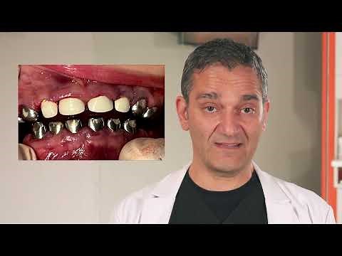Why You See Silver Crowns on Kids - White Zirconia Crowns From Dallas Fort Worth Pediatric Dentist