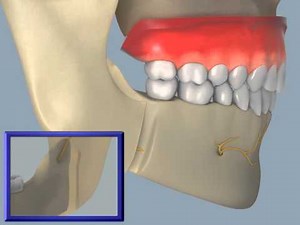 Sagittal Split Osteotomy