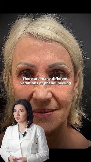 What is a Phenol Chemical Peel?