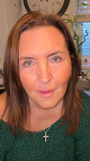 #botox #jowels #8pointfacelift #facelift #nonevasivefacelift #botoxfacelift | Sylvia Thomas