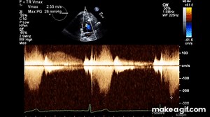 Normal Complete 2D Echocardiogram with Color Doppler and Spectral Doppler on Make a GIF