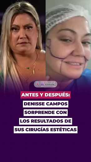 1.6M views · 9.2K reactions | Antes y después: Denisse Campos sorprende con los resultados de sus cirugías estéticas #chile #farandulachilena #tvchilena | Te Caché | Facebook