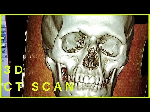 3D CT | 3D CAT Scan | GE Revolution 50 Slice