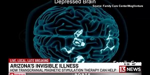 13 News anchor shares experience with TMS depression treatment