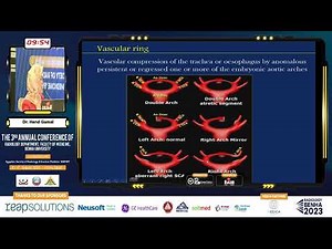 Spectrum of Congenital Aortic Arch Anomalies