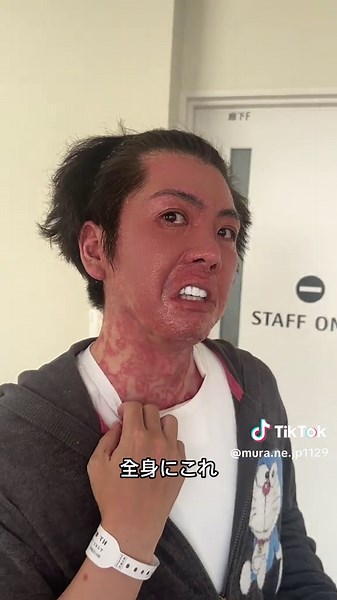 落葉状天疱瘡の症状とキャバクラ文化