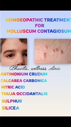 molluscum contagiosum #poxviruses #viralinfection