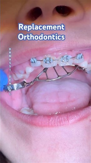 Tongue Guard, Orthodontic Devices