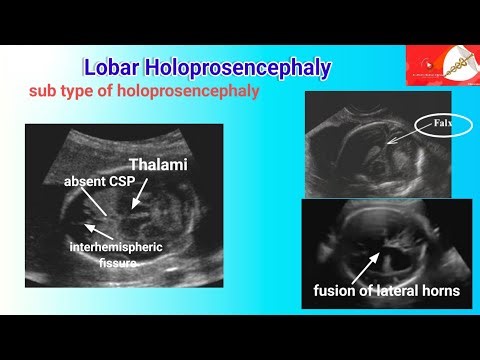 lobar holoprosencephaly