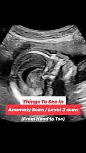 👶 Anomaly Scan: Head-to-Toe Check! 🧠 Head & Brain #BrainCheck #SkullShape 👀 Face #FacialCheck #CleftScreening 🔄 Spine #SpinalHealth #BackboneCheck ❤️ Heart #TinyHeart #HeartbeatCheck 🌬 Lungs & Diaphragm #BreathingBegins #LungHealth 🍽 Stomach & Abdomen #DigestiveHealth #BellyCheck 🚰 Kidneys & Bladder #UrinaryCheck #KidneyHealth ✋ Arms & Hands #TinyFingers #HandCheck 🦵 Legs & Feet #GrowingLegs #FootCheck 🩸 Placenta & Cord #LifelineCheck #CordHealth #PregnancyScan #AnomalyScan #BabyCheck #