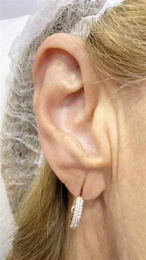 Detalhes que fazem diferença ✨ Lobuloplastia com técnica precisa e resultado natural. #harmonizaçãoauricular #lobuloplastia #transformaçãoreal | Dhalylla de Oliveira