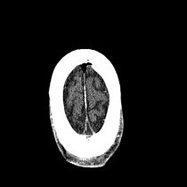 Video: Surgical Training for the Implantation of Neocortical Microelectrode Arrays Using a Formaldehyde-fixed Human Cadaver Model