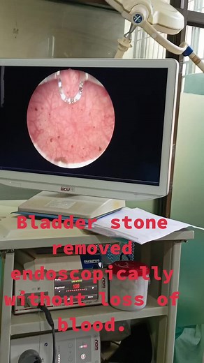 Bladder stone removed endoscopically without loss of blood. #bladderstones #kidneydisease