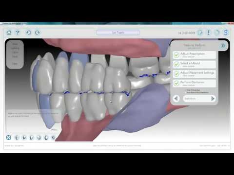 AvaDent digital dentures: Laboratory fabrication process