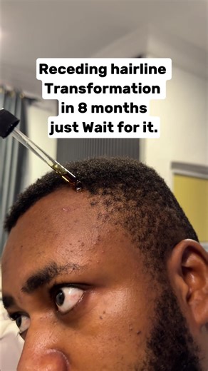Receding Hairline Restoration Techniques
