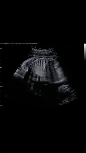 1.8K views · 13 reactions | Watch the baby practice breathing 殺 #jerbearimaging #pregnancyultrasound #baby #practice #practicemakesperfect ...In the third trimester, babies practice breathing in the womb by making rhythmic movements of their diaphragm, even though they don't actually inhale air. These movements, which are observable via ultrasound, are a sign of healthy lung development and a well-oxygenated fetus. | JerBear Imaging | Facebook