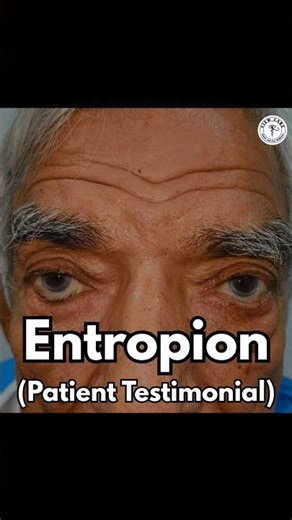 “Aankhon Me Jalan Aur Chubhan Thi…” | Entropion Patient Story 👁️