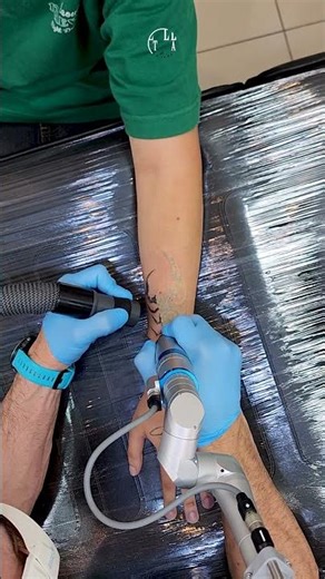 Remoção de escorpião no braço | Remoção de Tatuagem