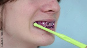 Plaque indicator on human teeth with braces. Plaque is colored pink. Teenager brush his teeth after using plaque indicator gel