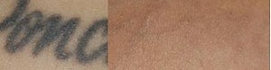 Tattoo Removal with Picosecond Laser - Connecticut Skin Institute