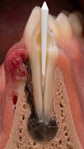 When Endodontics meets Periodontics.