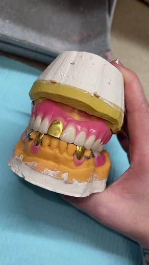 Putting Gold Teeth into Dentures: A Step-by-Step Guide