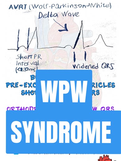ECG Study Note: WPW Pattern. Accessory pathway and delta wave overview. #ecg #medicaleducation #cardiology #nursingstudent #electrophysiology