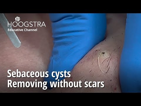 Sebaceous cysts - Removing without scars - 23071