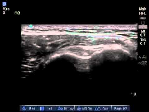 How To: Biceps Tendon Ultrasound Exam Scanning Technique
