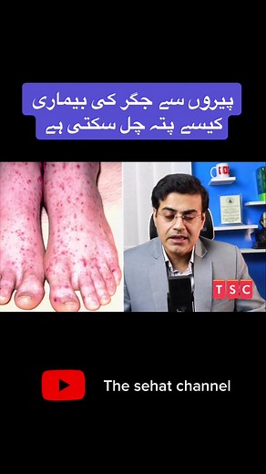 How foot indicates liver diseases #fypシ #foryou #tiktok #viralvideo #tiktokpakistan #tiktokindia #lifestyle