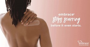 Prevent scars from becoming thick, dark, and raised with scar therapy from embrace® Active Scar Defense. embrace® is a patented, easy-to-apply dressing that actively prevents scar formation before it starts. | Embrace Scar Therapy
