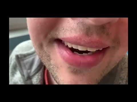 Voice Deepening/Masculinization Surgery, Prof Dr Kursat Yelken