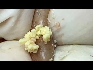 MASSIVE PIMPLE POPPING Satisfying Videos With Vieng Spa #116