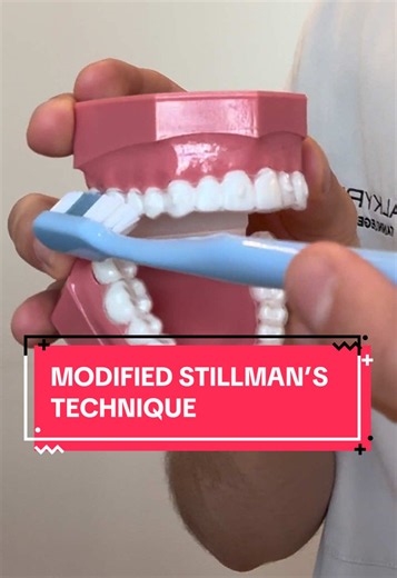 Riktig pussing: Modified Stillman’s teknikk for bedre tannhelse