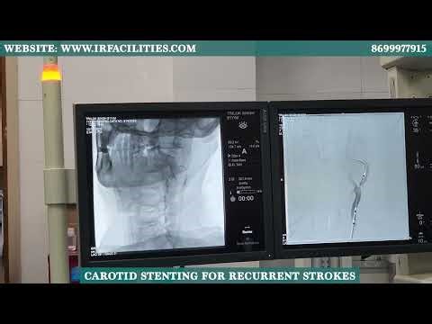 Carotid Stenting for Recurrent Strokes | Dr. Sandeep Sharma | IRFACILITIES