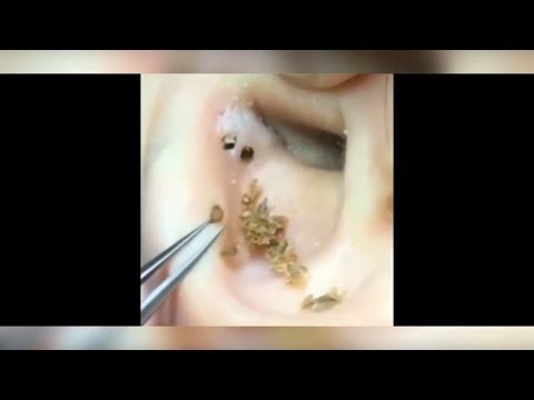Satisfying Pimple Popping & Cyst Extractions - 111