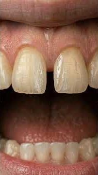 This Front Teeth Gap Was Closed Without Braces – Watch the Amazing Smile Transformation!