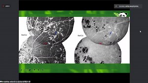 高视云学院-大咖讲多模式影像系列-黄厚斌教授：吲哚青绿血管造影(ICGA)第三讲